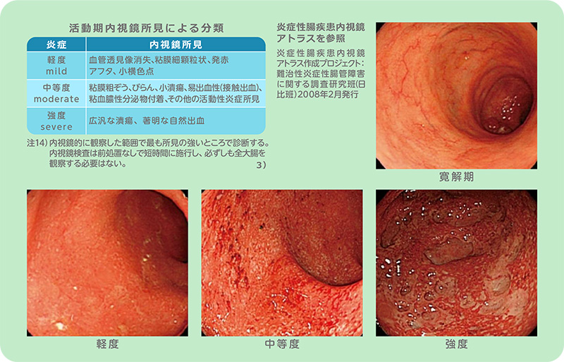病態の分類■活動期内視鏡所見による分類