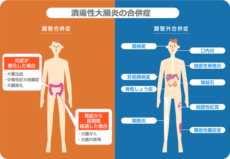 潰瘍性大腸炎の合併症