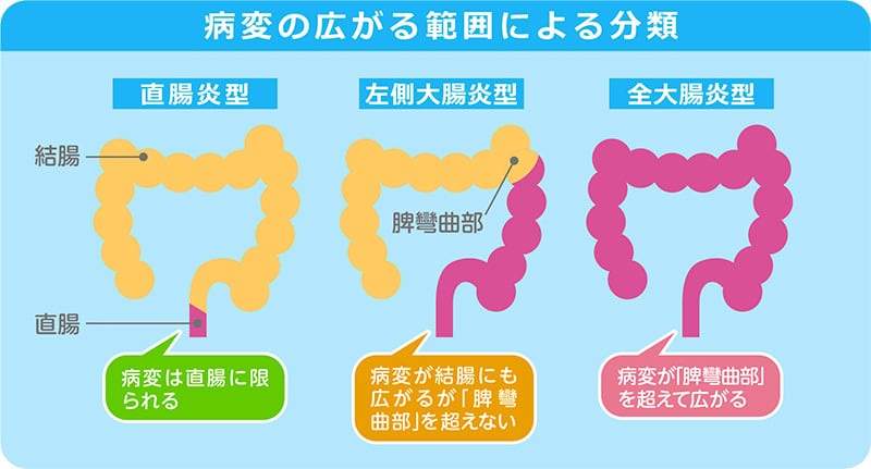 病変の広がる範囲による分類