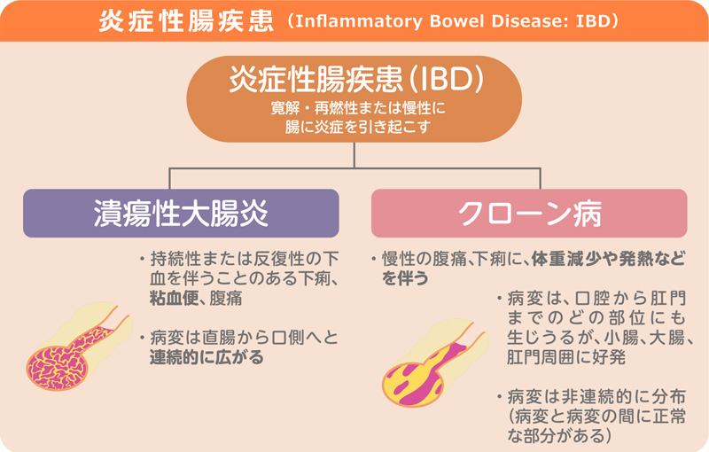 炎症性腸疾患（Inflammatory Bowel Disease：IBD）